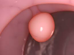 Polyps are abnormal growths of tissue that project from mucous membranes. What Is A Cervical Polyp And How Do You Get One