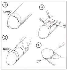 The swelling usually goes down within 2 to 3 weeks after surgery. Kids Circumcision Serving Greater California Area Culver City Ca Gentle Circumcision