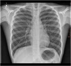 Image result for Chest XRay Interpretation