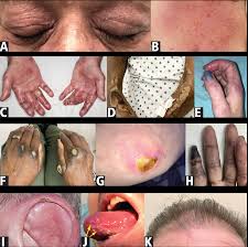 Image result for Dermatomyositis