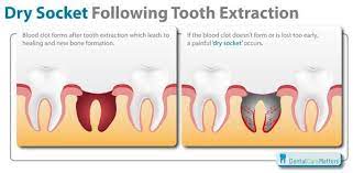 Luxuriant Wisdom Teeth Problems Oralhealthafrica Teethwhiteninghomemade Wisdom Tooth Extraction Tooth Extraction Wisdom Teeth