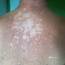 Roschenflechte Pityriasis Rosea Ursachen Therapie Derma Plus