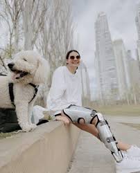 Despite the odds, a dancer beats cancer, uses robotic leg to dance