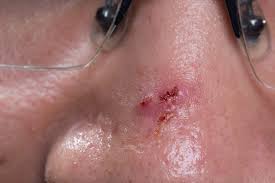 Basal cell carcinoma is the most common type of skin cancer. Basal Cell Carcinoma Treatment U S Dermatology Partners