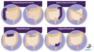 In de dunne darm symptomen en verloop. Darmoperatie Bij Dikkedarmkanker Colorectaal Carcinoom Darmkanker