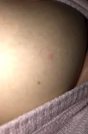 Instead, you may notice a rash that looks like an insect bite. Red Mark On Breast Mumsnet