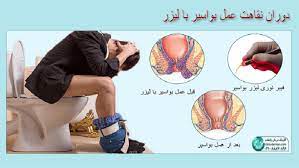 عکس قبل و بعد از عمل بواسیر + بواسیر چیست با عکس