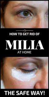 How To Get Rid Of Milia At Home The Safe Way Thebeautymania Net Skin Bumps Face Skin Care Skin Spots