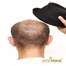 Esteprime Hair Transplantation Adli Kullanicinin Sac Ekimi Yontemleri Panosundaki Pin Sac