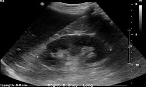 Image result for Perinephric Abscess