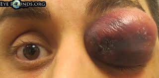 The sample is sent to a lab where it's placed in a dish of nutrients that encourage bacterial growth. Methicillin Resistant Staphylococcus Aureus Mrsa Preseptal Cellulitis