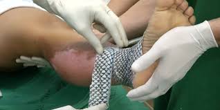 Brazilian Doctors Are Using Fish Skin To Treat Burn Victims Here S Why Treat Burns Skin Grafting Severe Burns
