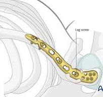 ORIF - Pre-contoured distal plate for Lateral, displaced ...