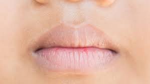 Coba gunakan 7 bahan alami ini untuk mengatasi bibir hitam. Sudut Bibir Menghitam Bagaimana Cara Menghilangkannya