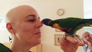 Alopecia personal story: What it's really like.