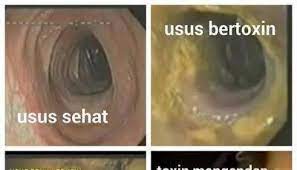 Berikut adalah tanda usus anda kotor, dan cara membersihkannya dengan aman. Ciri Ciri Usus Kotor Penyakit Yang Ditimbulkan Dan Mengatasinya