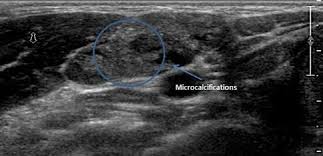 Pin On Thyroide
