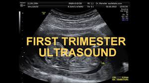Image result for First Trimester Ultrasound