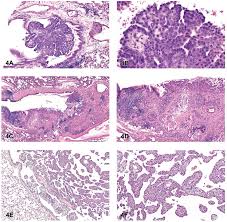 Maybe you would like to learn more about one of these? Bronchial Tumors And Mesothelioma A Bronchial Adenoma Papillary Download Scientific Diagram