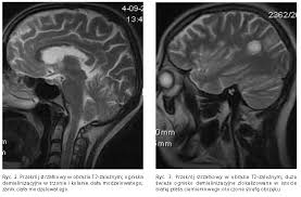 To badanie polega na wytworzeniu pola magnetycznego wokół badanej osoby,. Stwardnienie Rozsiane Diagnostyka Psychiatria Medycyna Praktyczna Dla Lekarzy