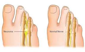 Sakit kaki sebelah kiri ketika berjalan sangat mengganggu aktivitas yang kita lakukan setiap harinya, terutama bagi anda para atlet ataupun bagi anda gejala sakit kaki sebelah kiri yang sering terjadi adalah seseorang yang mengalami sakit kaki sebelah kiri pasti akan merasakan rasa nyeri baik nyeri. Bukan Hanya Pegal Biasa Rasa Sakit Pada Kaki Bisa Menjadi Ciri Penyakit Kaki Berikut Ini Beauty Journal