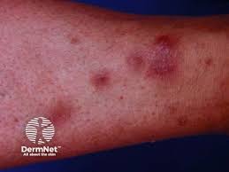 Image result for Panniculitis