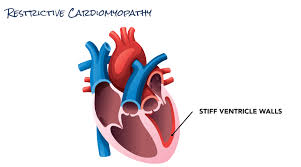 Image result for Cardiomyopathy