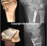 Volar marginal rim fractures of the distal radius ...