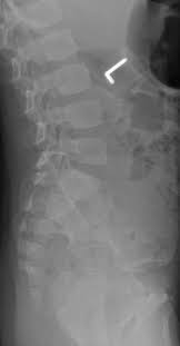Lumbar Spine Ap Pa View Radiology Reference Article Radiopaedia Org