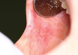 Oral Lichen Planus Causes Symptoms And Homeopathic Treatment Drrajeevclinic Com