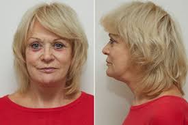 Sherrie hewson news, gossip, photos of sherrie hewson, biography, sherrie hewson boyfriend list 2016. Sherrie Hewson Cries As She Reveals New Face After Fearing She Would Die During Facelift Operation Mirror Online