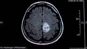 A brain tumor occurs when abnormal cells form within the brain. Brain Tumors In Children When All That Matters Is Now Science In Depth Reporting On Science And Technology Dw 08 06 2020