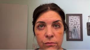 I am getting my upper bleph (& a rhinoplasty) done in Turkey in a month.  What do you recommend I take with me for after care & comfort. Note: I have  been