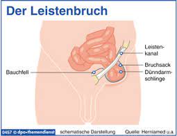 Was Ist Ein Leistenbruch Operation Und Was Passiert Bei Einer Bravo