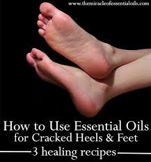 How to use essential oils for feet. 7 Essential Oils For Cracked Heels 3 Recipes That Help The Miracle Of Essential Oils