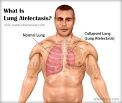 What Is Lung Atelectasis What Is Its Pathophysiology