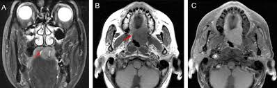 A lung tumor is an abnormal rate of cell division or cell death in lung tissue or in the airways that lead to the lungs. Differentiation Between Benign And Malignant Palatal Tumors Using Conventional Mri A Retrospective Analysis Of 130 Cases Oral Surgery Oral Medicine Oral Pathology And Oral Radiology