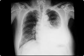 In patients with symptomatic malignant pleural effusions with nonexpandable lung, failed pleurodesis, or loculated effusion, we suggest the use of ipcs over chemical pleurodesis. Lti 01 Lung Therapeutics