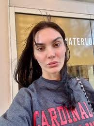 My four week progression; temporal lift, cat eyes, midface lift. I'm happy  with my natural look! Feel free to ask any questions