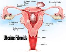 Dosteo who makes efforts to help people in poor local community in south sudan. Homeopathy Approach In Uterine Fibroid Can Avoid Uterus Removal Surgery Healthcare Health Lifestyle Health Fibroids Treatment Fibroids Uterine Fibroids