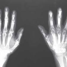 Pdf Complex Regional Pain Syndrome Crps Type 1 Following Snake Bite A Case Report