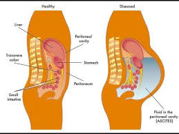 Fluid Accumulates In Your Abdomen Signs Symptoms An Type Natural Treatme Abdomen Signs And Symptoms Symptoms