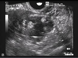 A pelvic ultrasound is a procedure that allows your doctor to look at what's going on inside your pelvis. Transvaginal Ultrasonography And Female Infertility Glowm