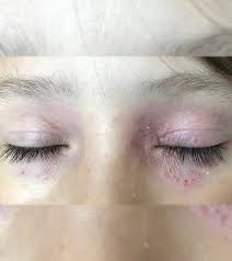 A biopsy of lymph nodes for hodgkin lymphoma, of skin for mycosis fungoides, or of bone marrow for polycythemia vera. 12 Home Remedies To Get Rid Of A Rash Around The Eyes