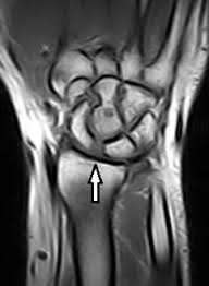 Image result for Scapholunate Dislocation