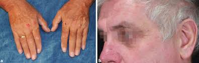 The clinical features of pellagra are dermatitis, diarrhea, and dementia. Seltene Erkrankungen An Der Haut Erkennen Springerlink