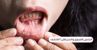 ماتشو بيتشو غبي التاجر المسافر الثآليل التناسلية عند النساء بالصور comertinsaat com