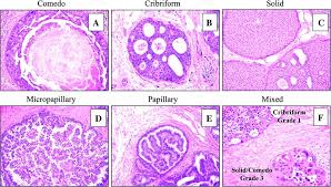 Pin Em Breast Pathology