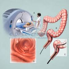 Image result for Virtual Endoscopy