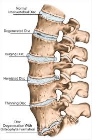 Degenerative Disc Disease Treatment And Self Care